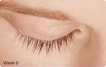 Latisse BA 01