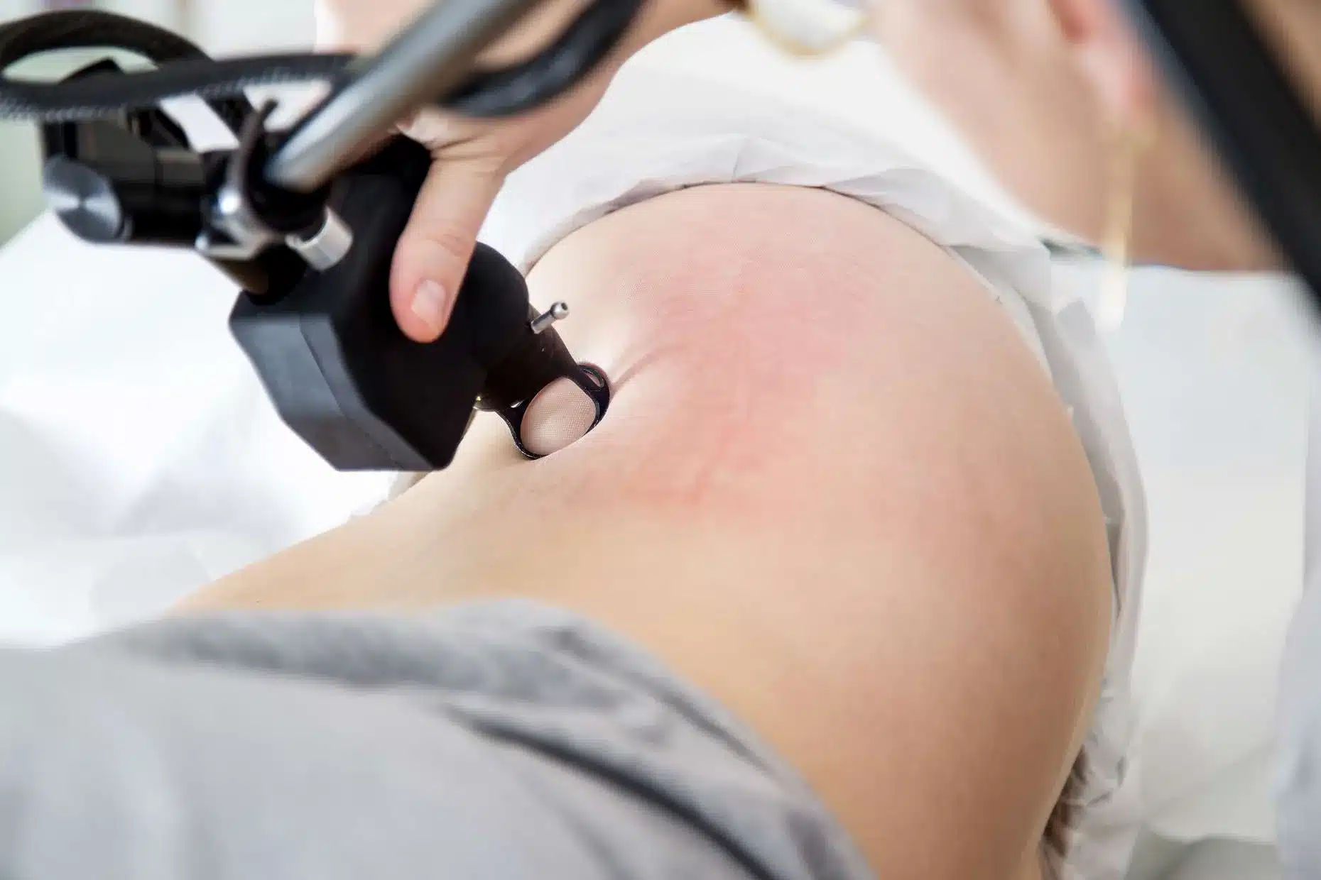 Scar Removal at Bella Medspa Philadelphia, PA