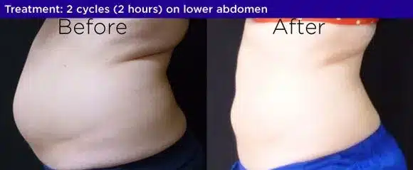 Coolsculpting before after 1