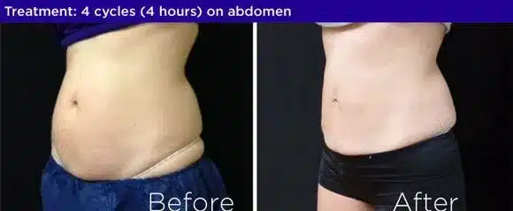 Coolsculpting before after 2