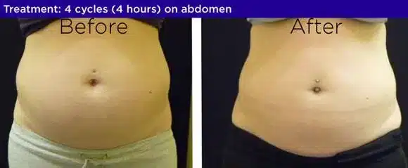 Coolsculpting before after 3