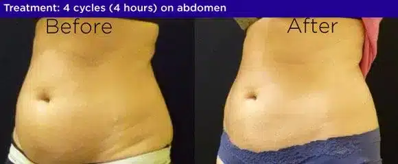 Coolsculpting before after 4