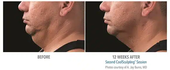 Coolsculpting chin before and after pictures 1