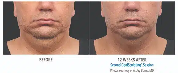 Coolsculpting chin before and after pictures 2