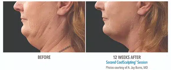 Coolsculpting chin before and after pictures 3