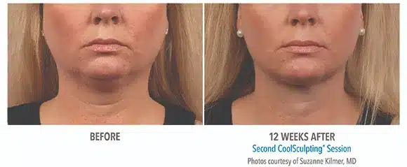 Coolsculpting chin before and after pictures 4