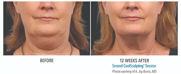 Coolsculpting chin before and after pictures 5