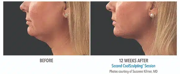 Coolsculpting chin before and after pictures 6