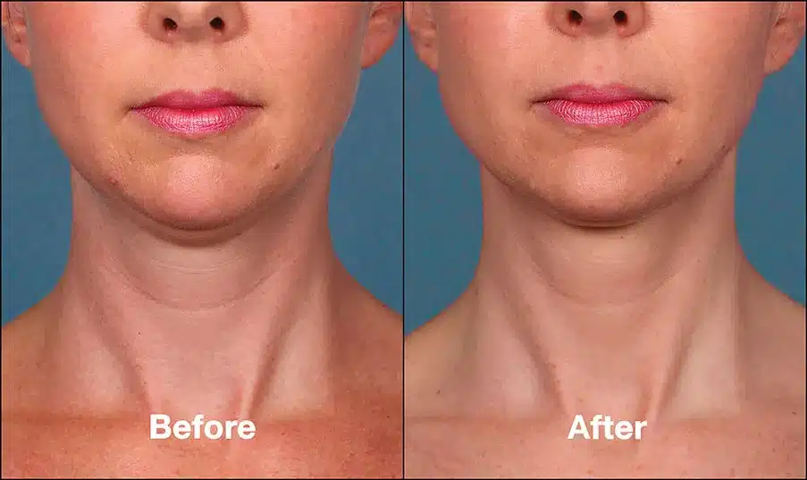 Double chin treatment kybella before after 1