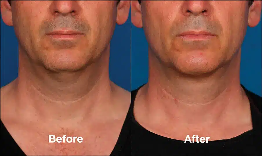 Double chin treatment kybella before after 13