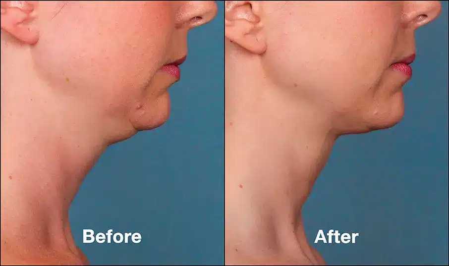 Double chin treatment kybella before after 2