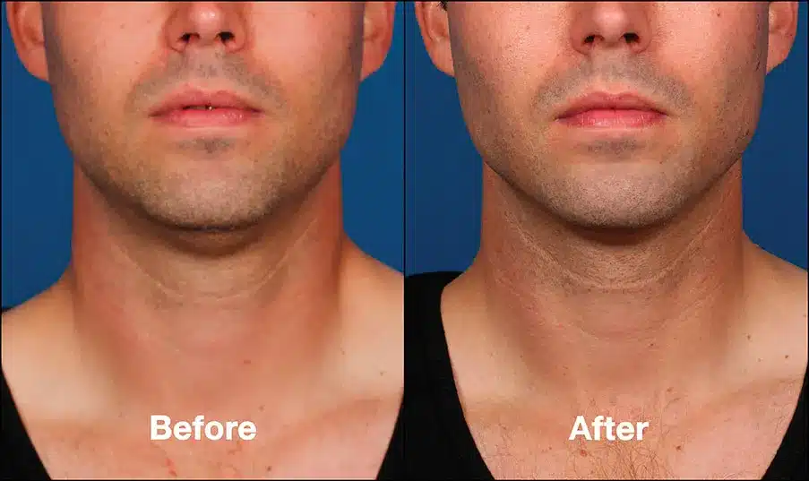 Double chin treatment kybella before after 3