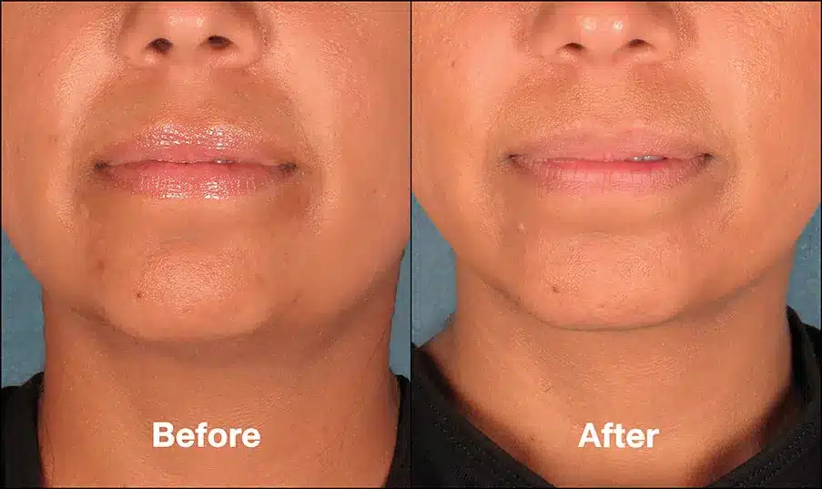 Double chin treatment kybella before after 9