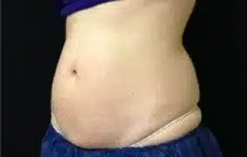 bella coolsculpting ba 03