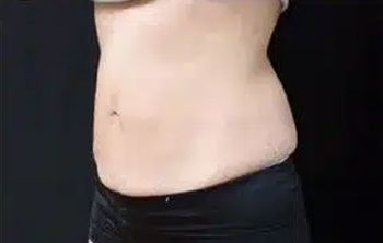 bella coolsculpting ba 04