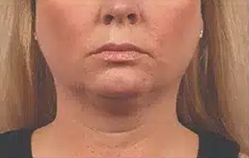 bella coolsculpting ba 05