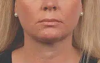 bella coolsculpting ba 06