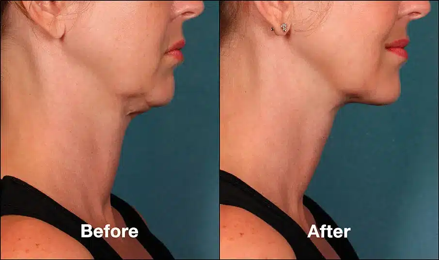 Kybella Before After Side Face Bella Medspa Philadelphia, PA