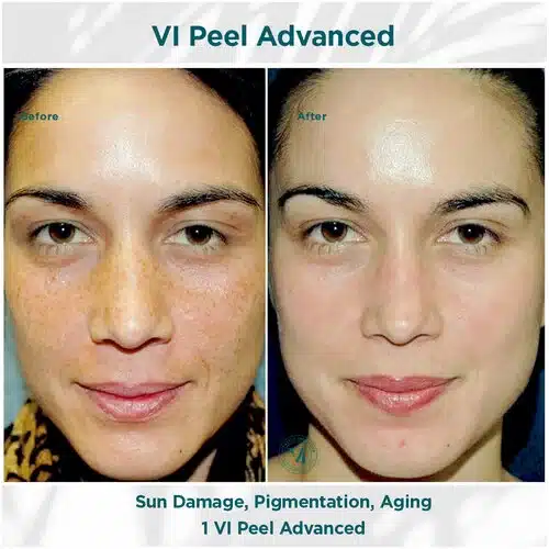 VI Peel Advanced Before and After after Bella medspa in Philadelphia, PA