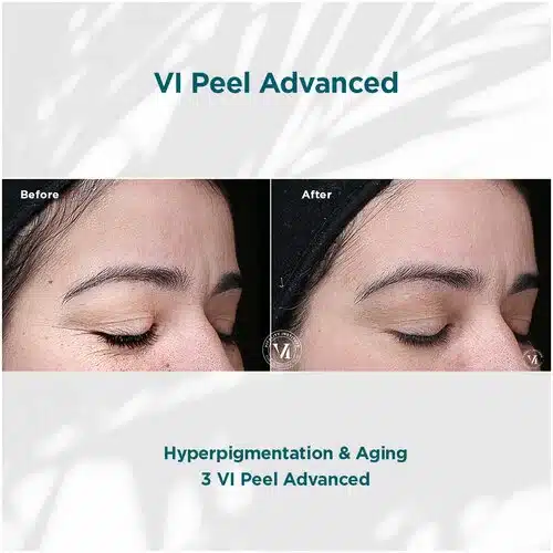 VI Peel Advanced Before and After Bella medspa in Philadelphia PA