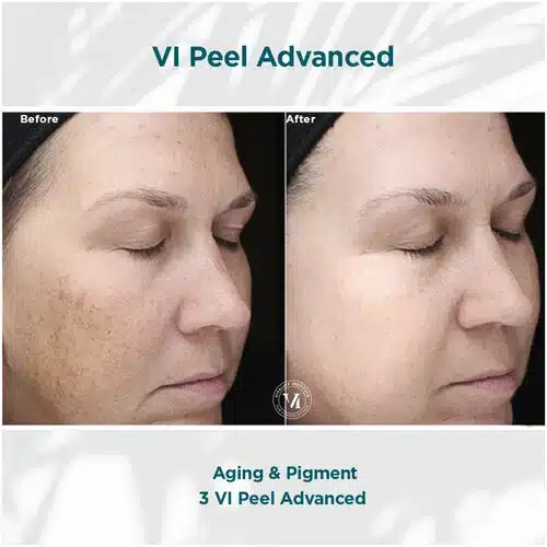 VI Peel Advanced Before and After Bella medspa in Philadelphia, PA