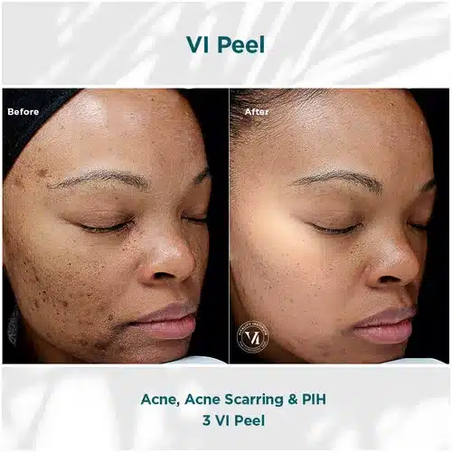 VI Peel Original Before and After by Bella Medspa in Philadelphia, PA