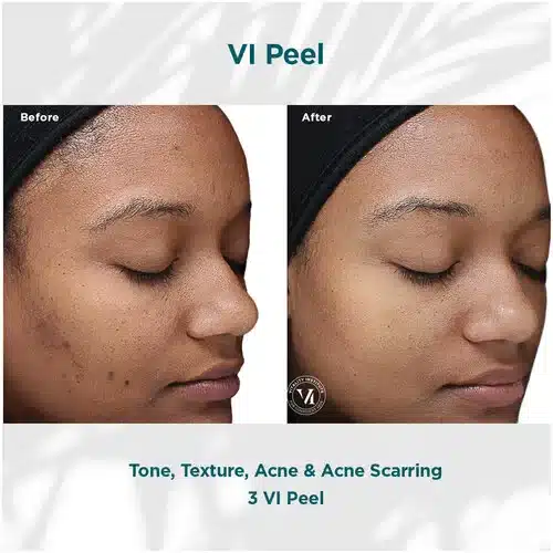 VI Peel Original Before and After Bella Medspa in Philadelphia, PA