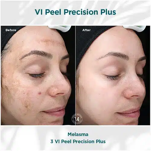 VI Peel Precision Plus Before and After Bella Medspa in Philadelphia, PA