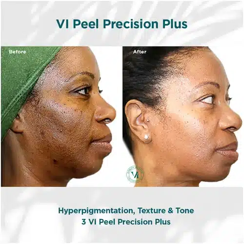 VI Peel Precision Plus Before and After Bella Medspa in Philadelphia, PA