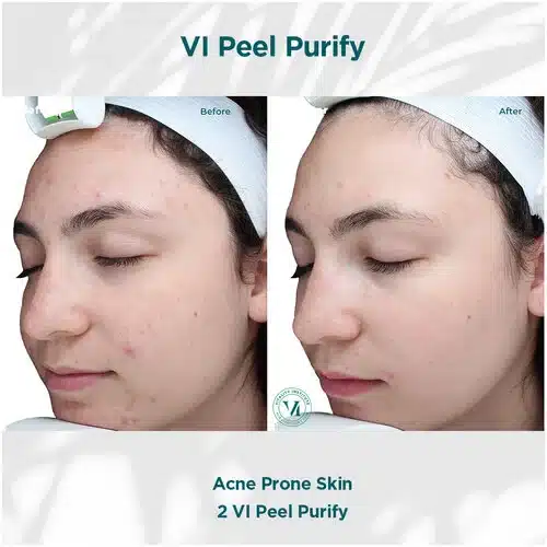 VI Peel Purify Service Before and After Bella Medspa in Philadelphia, PA