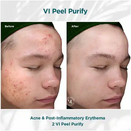 VI Peel Purify Service Before and After Bella Medspa in Philadelphia, PA