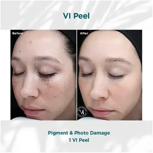 VI Peel Services Original Before and After Bella Medspa in Philadelphia, PA