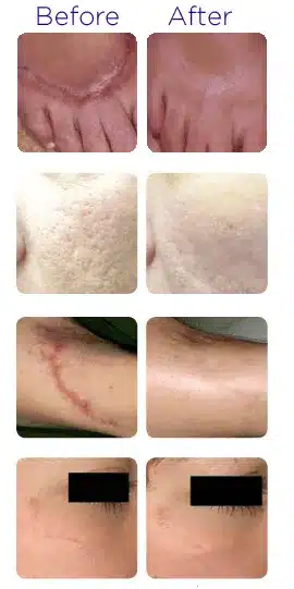 Laser scars removal before after by Bella Medspa Philadelphia, PA