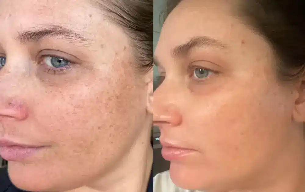 Ipl photofacial before & after