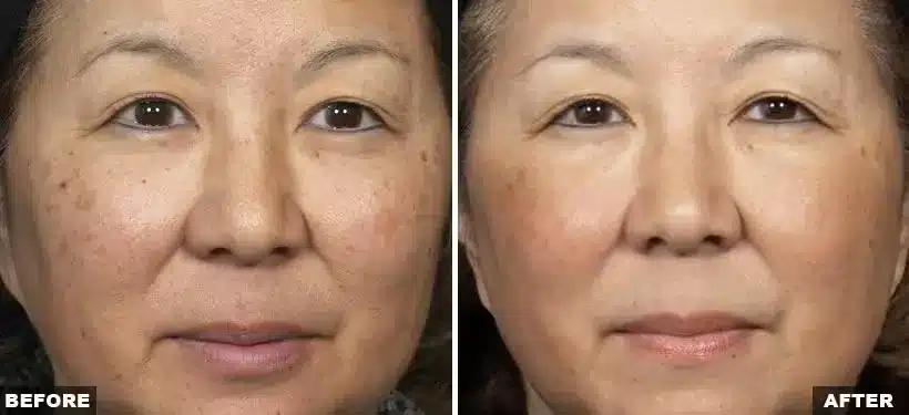 Laser skin resurfacing before and after 1