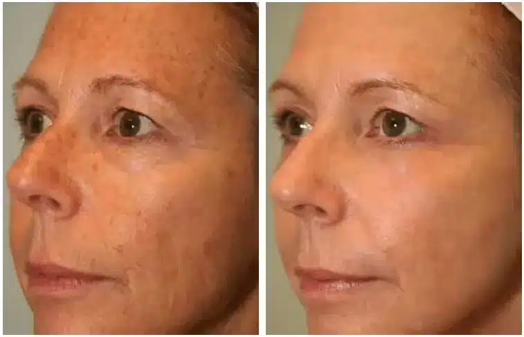 Laser skin resurfacing before and after 2