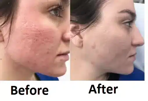 Laser skin resurfacing before and after 3