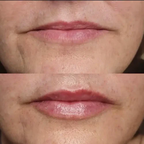 Lip injections before & after 3