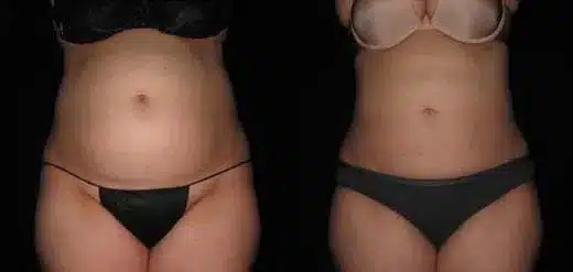 Smartlipo before and after pictures 10