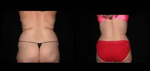 Smartlipo before and after pictures 13