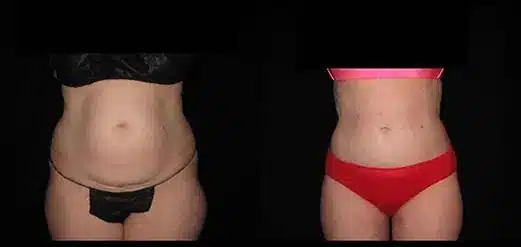 Smartlipo before and after pictures 15