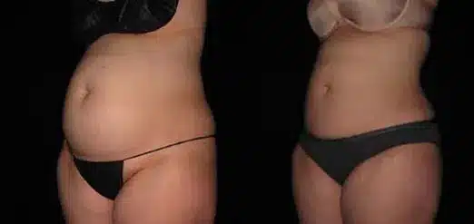 Smartlipo before and after pictures 4