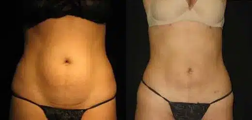 Smartlipo before and after pictures 7