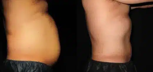 Smartlipo before and after pictures 8