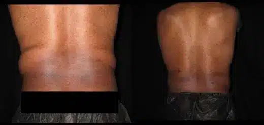 Smartlipo before and after pictures 9