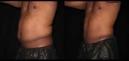 Smartlipo before and after pictures