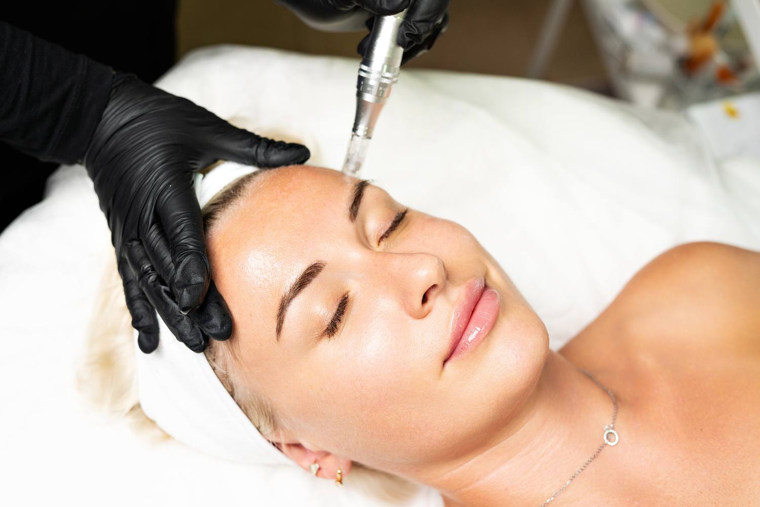 What Is Microneedling
