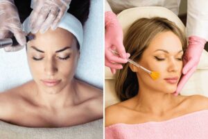 Chemical Peel vs. Microneedling