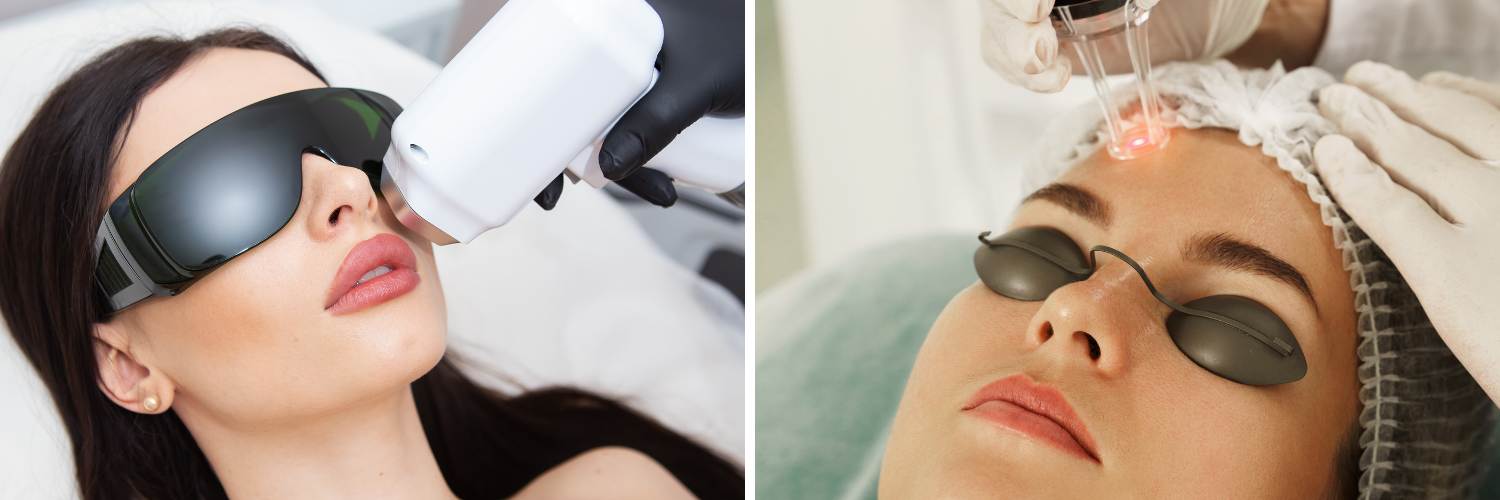 Lasers IPL vs. Laser Resurfacing
