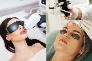 Lets Talk Lasers IPL vs Laser Resurfacing